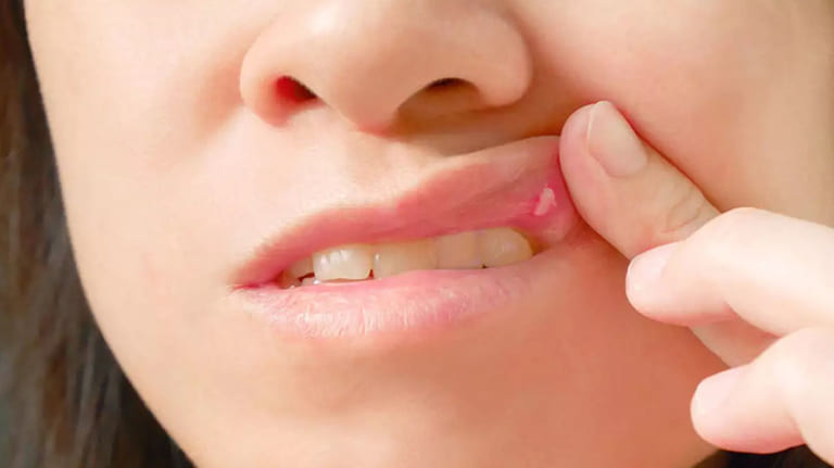 Cách chữa nhiệt miệng