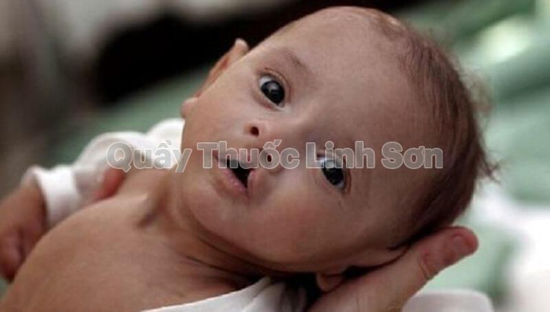 cảm cúm khi mang thai có thr gây ra dị tật ở thai nhi
