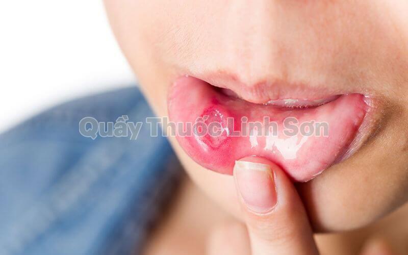 nguyên nhân bị nhiệt miệng