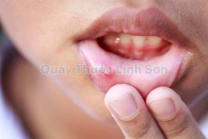 nhiệt miệng là gì